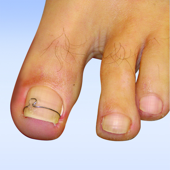 Nagelkorrekturspange - Podologie Bantleon